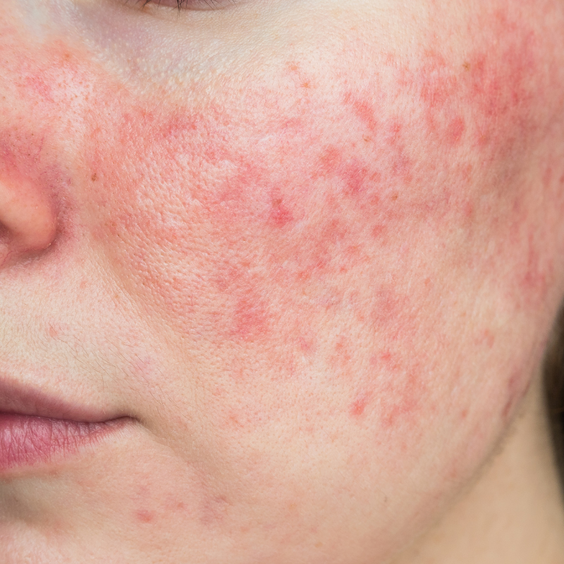 Rosacea & Couperose