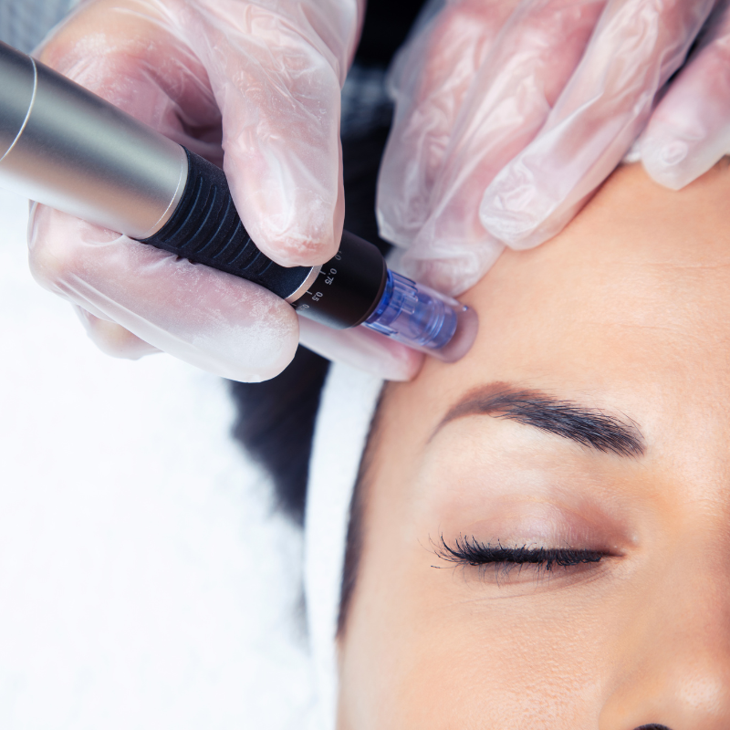 Microneedling– moderne Hautpflege mit Tiefenwirkung