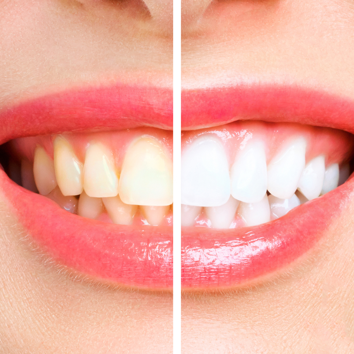 Kosmetisches Zahnbleaching schonend und schmerzarm