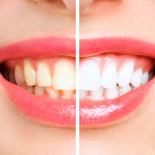 Kosmetisches Zahnbleaching schonend und schmerzarm